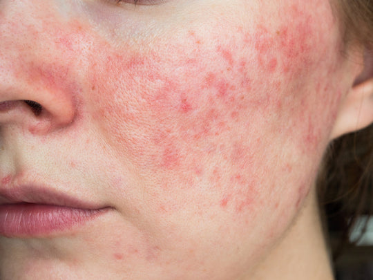 microneedling for rosacea