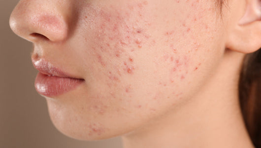 microneedling for PIE