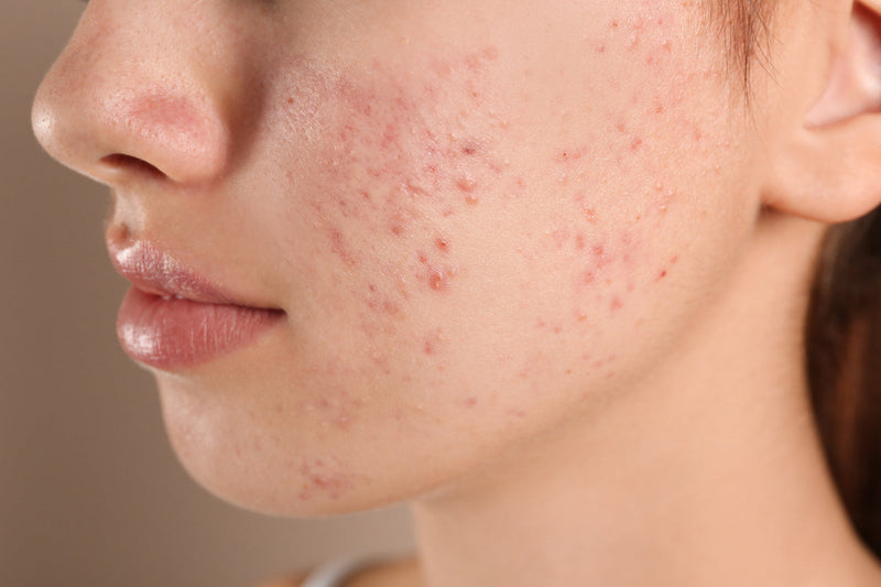microneedling for PIE