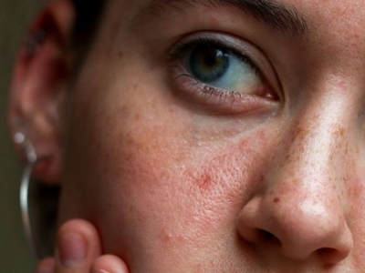 How Cortisol Affects the Skin: The Stress-Skin Connection and What You Can Do