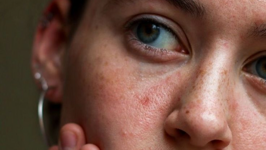 How Cortisol Affects the Skin: The Stress-Skin Connection and What You Can Do