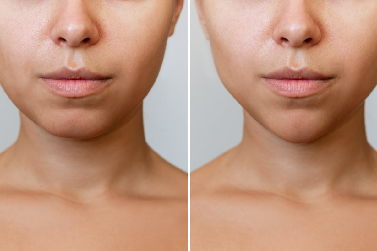 Before and after facial comparison examining does red light therapy cause fat loss in the face concerns.