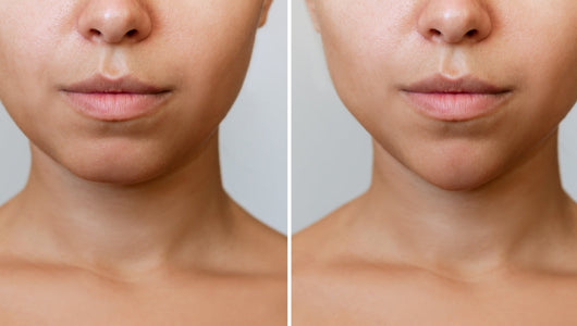 Before and after facial comparison examining does red light therapy cause fat loss in the face concerns.