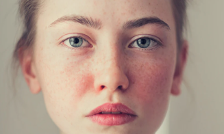 Seeing Red: Red Light Therapy and Rosacea