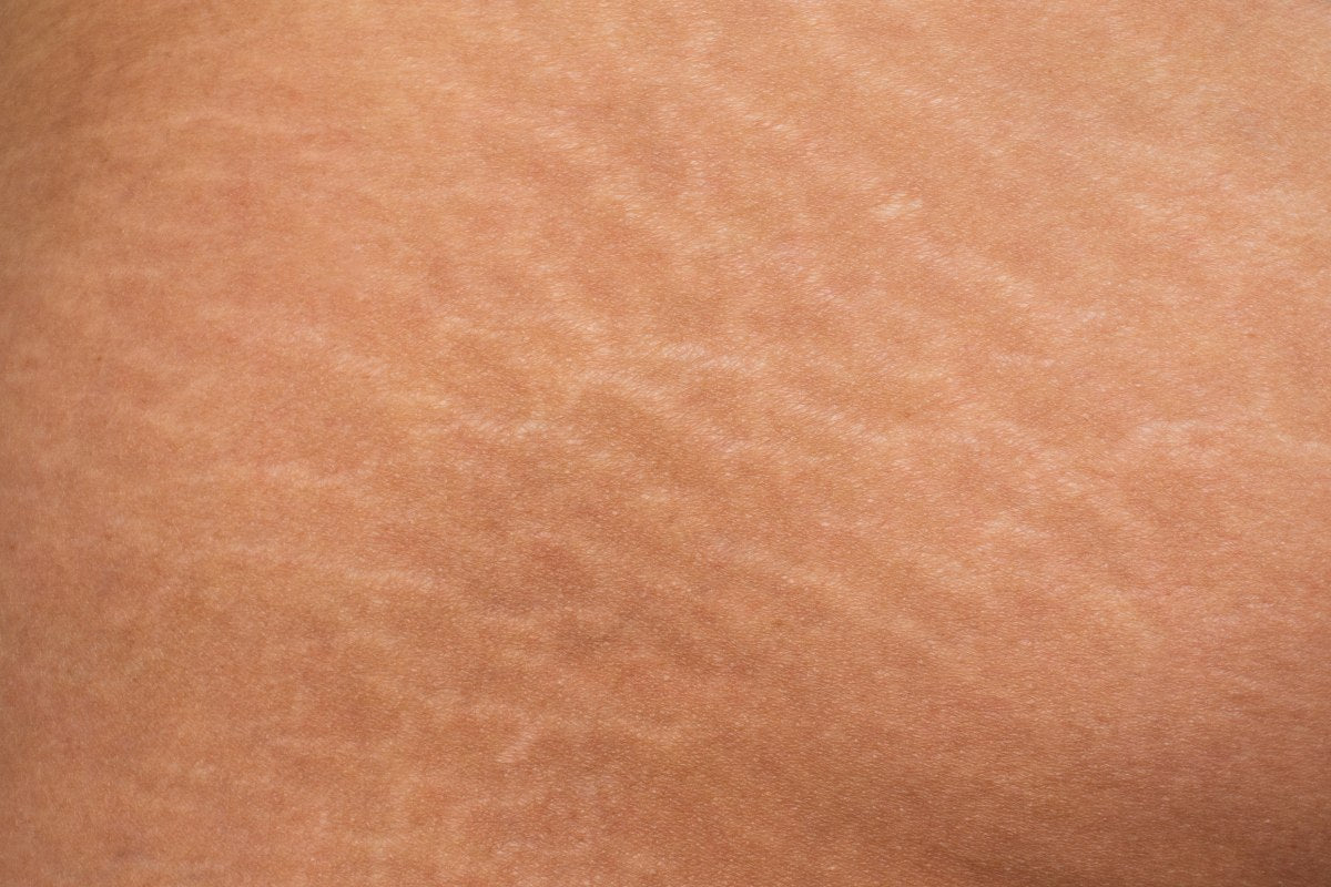 Red Light Therapy Stretch Marks