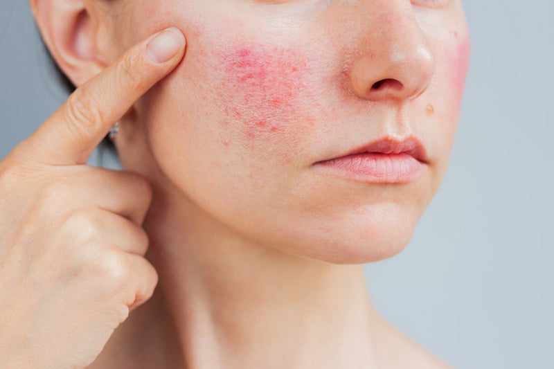 Woman with skin irritation, wondering does red light therapy help heal wounds_jpeg