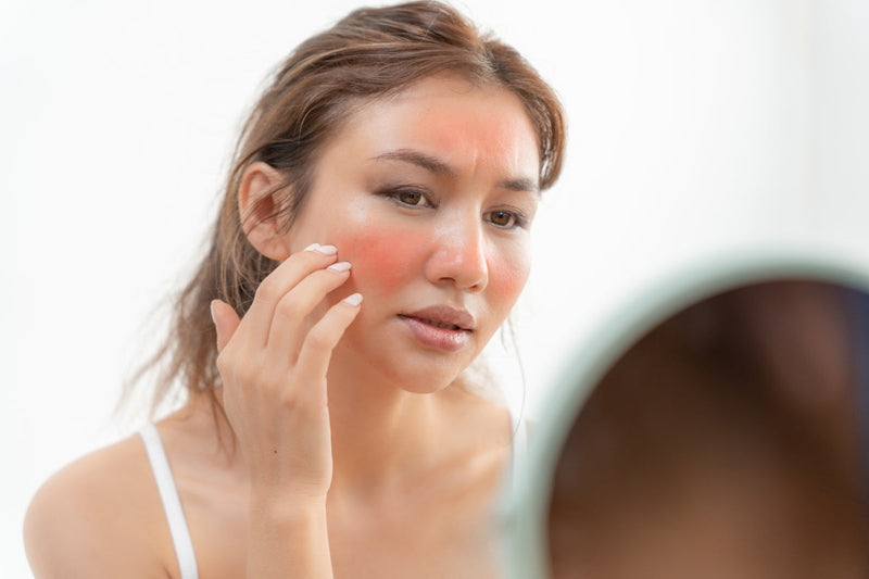 Women with sunburn on face considering red light therapy for the sunburn.