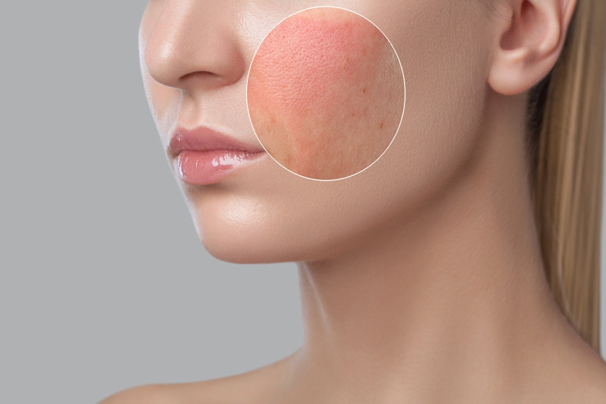 Zoom in on irritated skin that is falsely attributed as red light therapy detox symptoms.