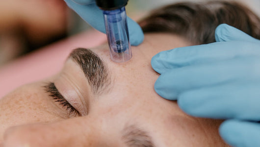 micro needling recovery time