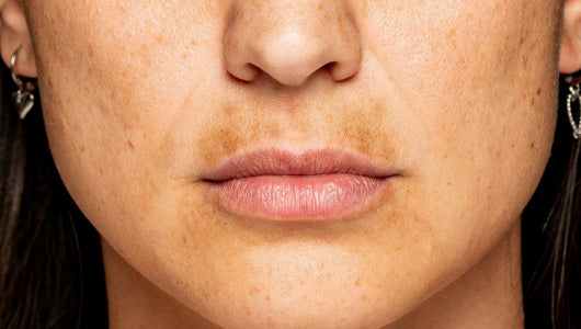 does red light therapy help fade dark spots