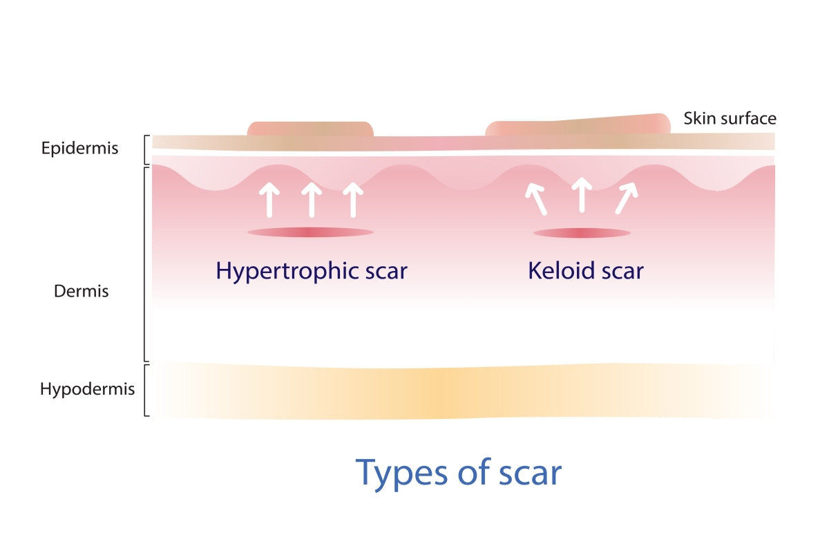 red light therapy keloid scars
