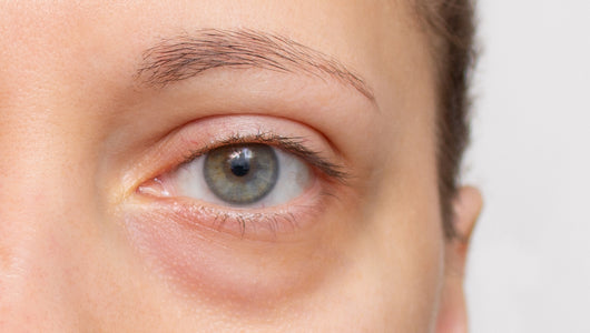 microneedling under eyes