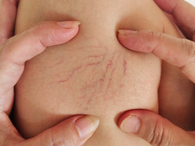 Red Light Therapy for Varicose Veins