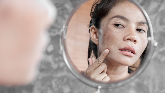 red light therapy melasma