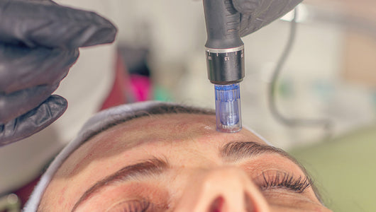 what does microneedling feel like