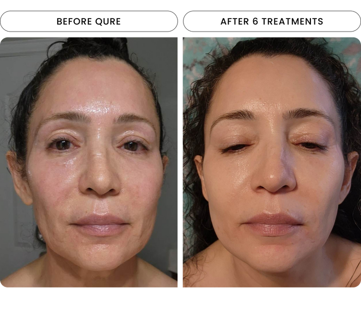 Micro-Infusion For Wrinkles (2 Refill Treatments)