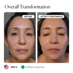 Micro-Infusion 1 Month Bundle (For Wrinkles)