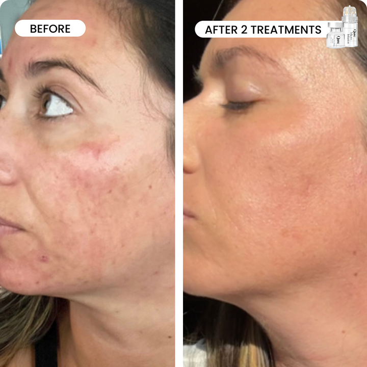 Micro-Infusion 1 Month Bundle (For Wrinkles)
