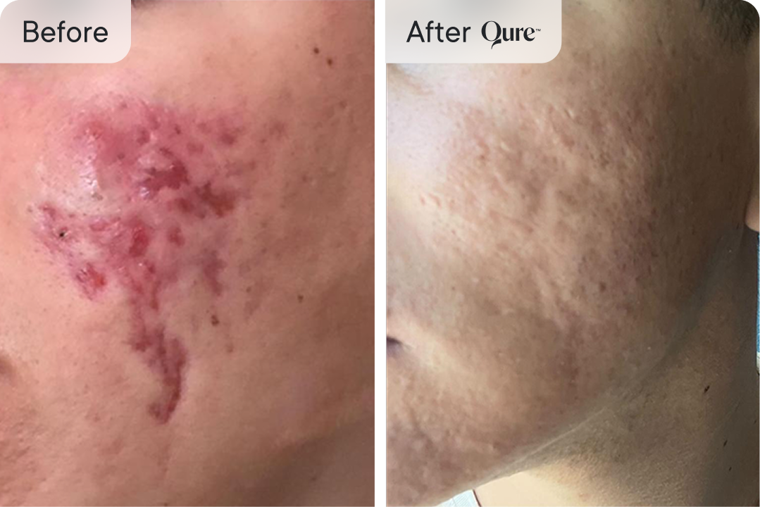 Acne scars before and after Qure treatment (Image 13)