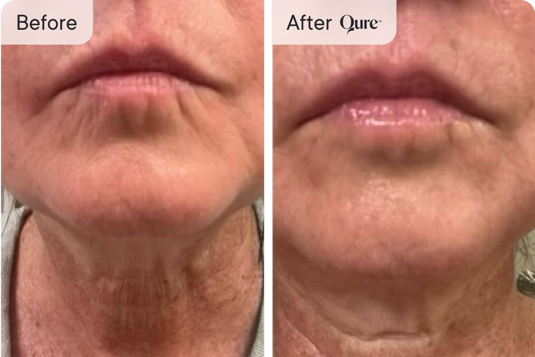 Before & After Qure lip wrinkles treatment