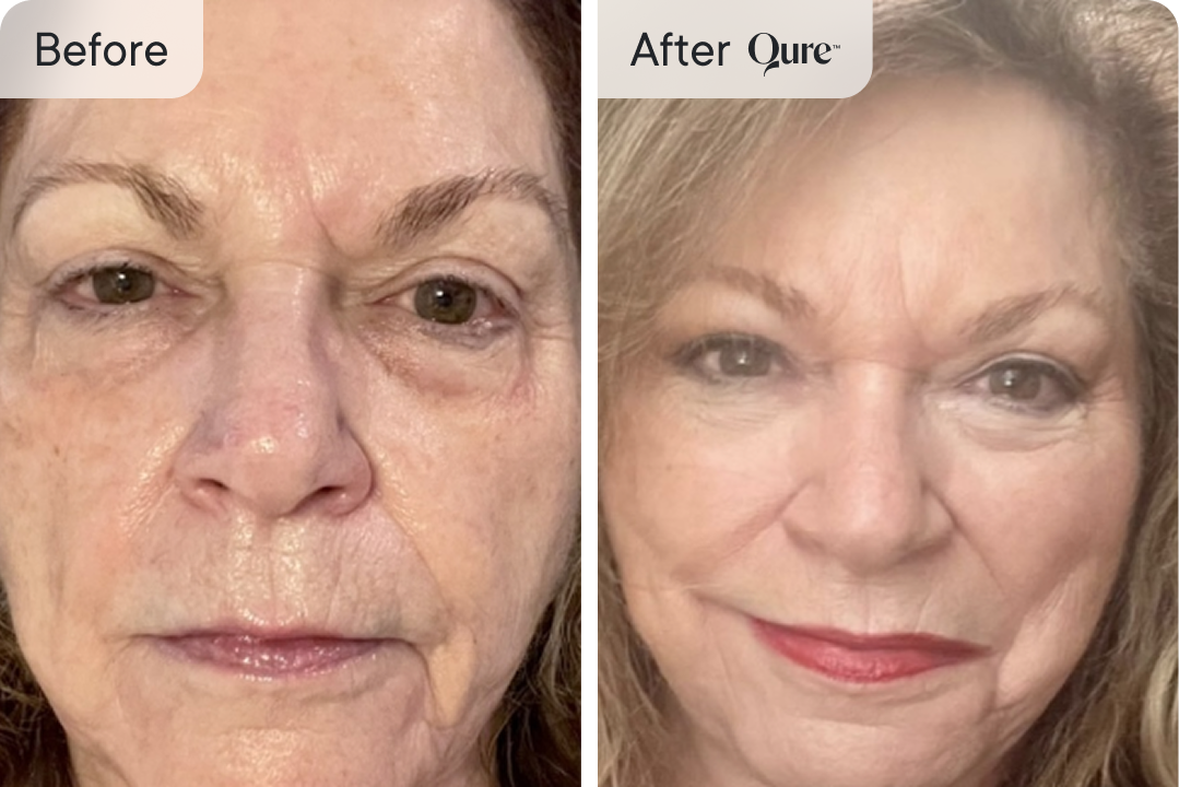 Before and After Qure skin treatment, Image 15