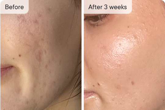 Comparison of skin before and after treatment.