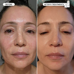 Micro-Infusion 3 Month Bundle (For Dark Spots)