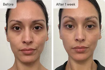 Skin improvement before and after one week.