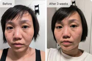 Facial changes after 3 weeks, a-1