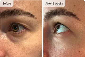 Comparison of eye area before and after 2 weeks.