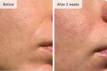 Skin pores before and after 2 weeks.