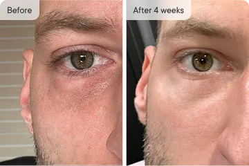 Close-up comparison of a man's face before and after 4 weeks.