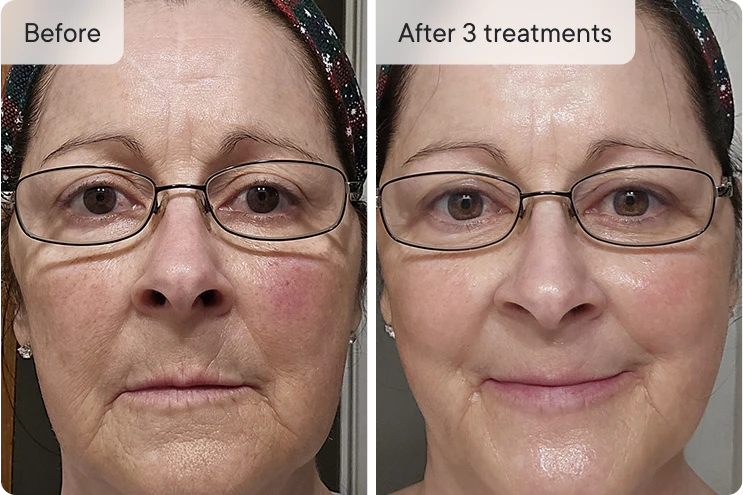Before and after skin treatment results