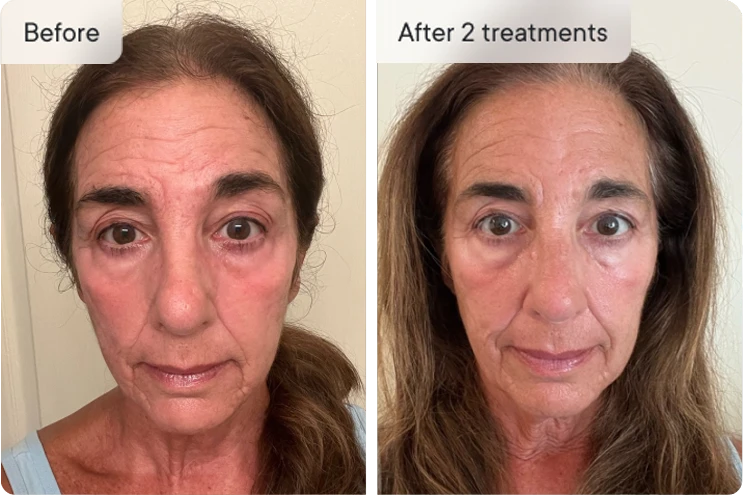 Woman's face before and after two treatments, showing wrinkles reduction.