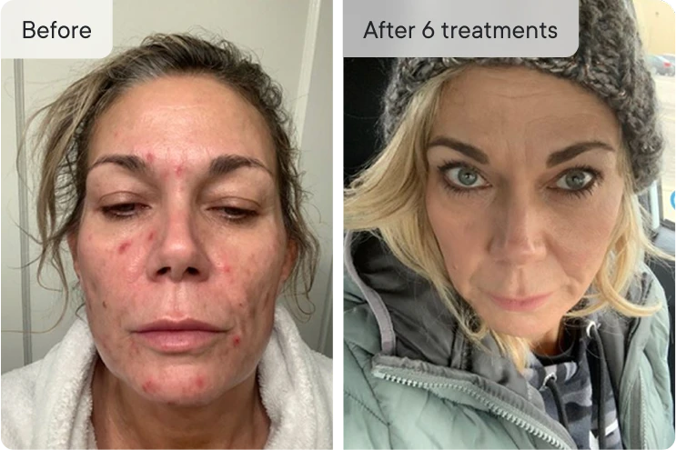 Before and after photos of a woman's face.