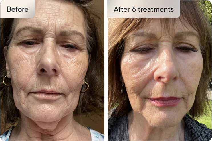 Before and after image of a woman's face.