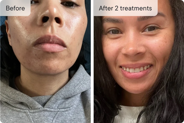 Before and after photos of a woman's face.