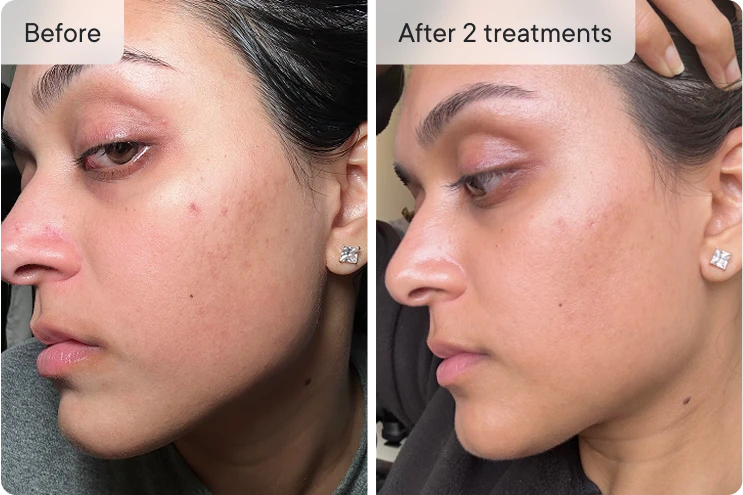 Side-by-side comparison of a woman's face before and after treatments.