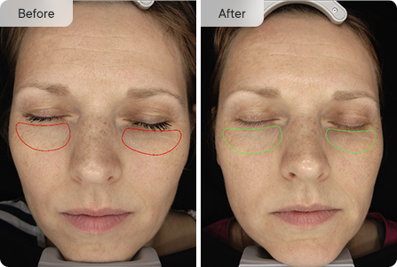 Before & After eye treatment results