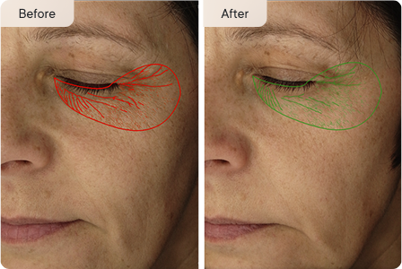 Before and After Eye Treatment (ab-2)