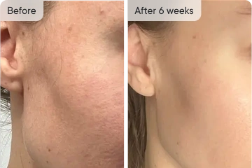 Bethany's skin before and after 6 weeks.