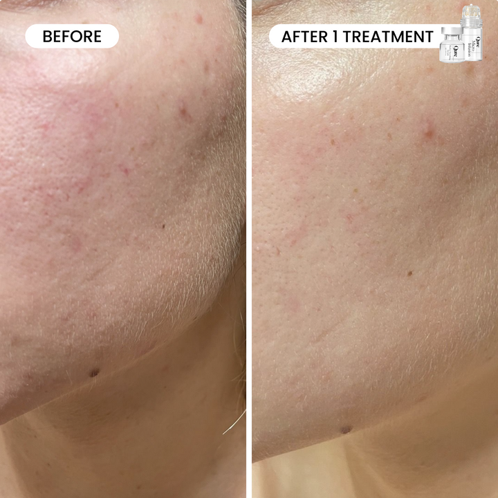 Micro-Infusion 1 Month Bundle (For Wrinkles + Dark Spots)