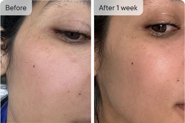 Jessica's before & after skin results after 1 week