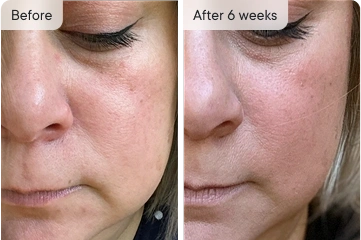 Johanna's face before and after 6 weeks, showing skin improvement.