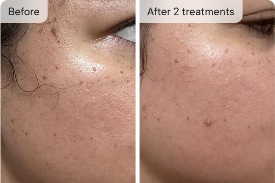 Kyla R's skin before and after 2 treatments