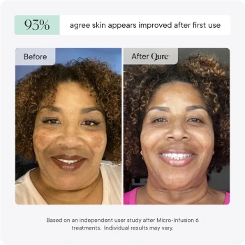 Micro-Infusion 3 Month Bundle (For Dark Spots)