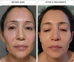 Before and after 6 treatments, facial rejuvenation