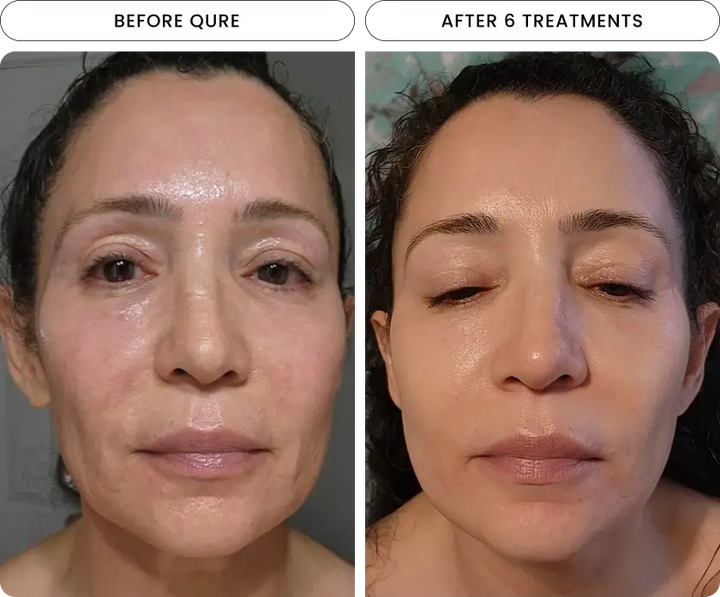 Before and after 6 treatments, facial rejuvenation