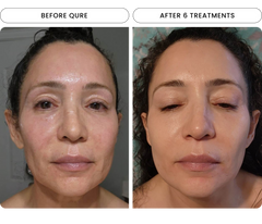 Micro-Infusion Brightening 1 Treatment