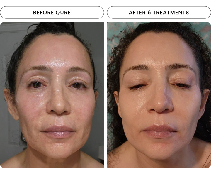 Micro-Infusion Brightening 1 Treatment